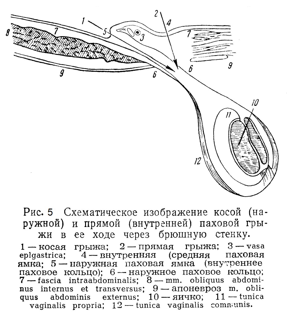Изображение косой (наружной) и прямой (внутренней) паховой грыжи
