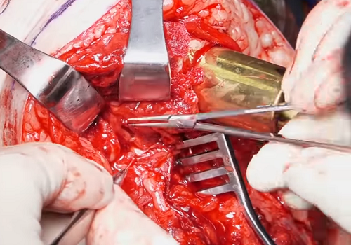 Перевязка лучевой артерии в мышечном отделе