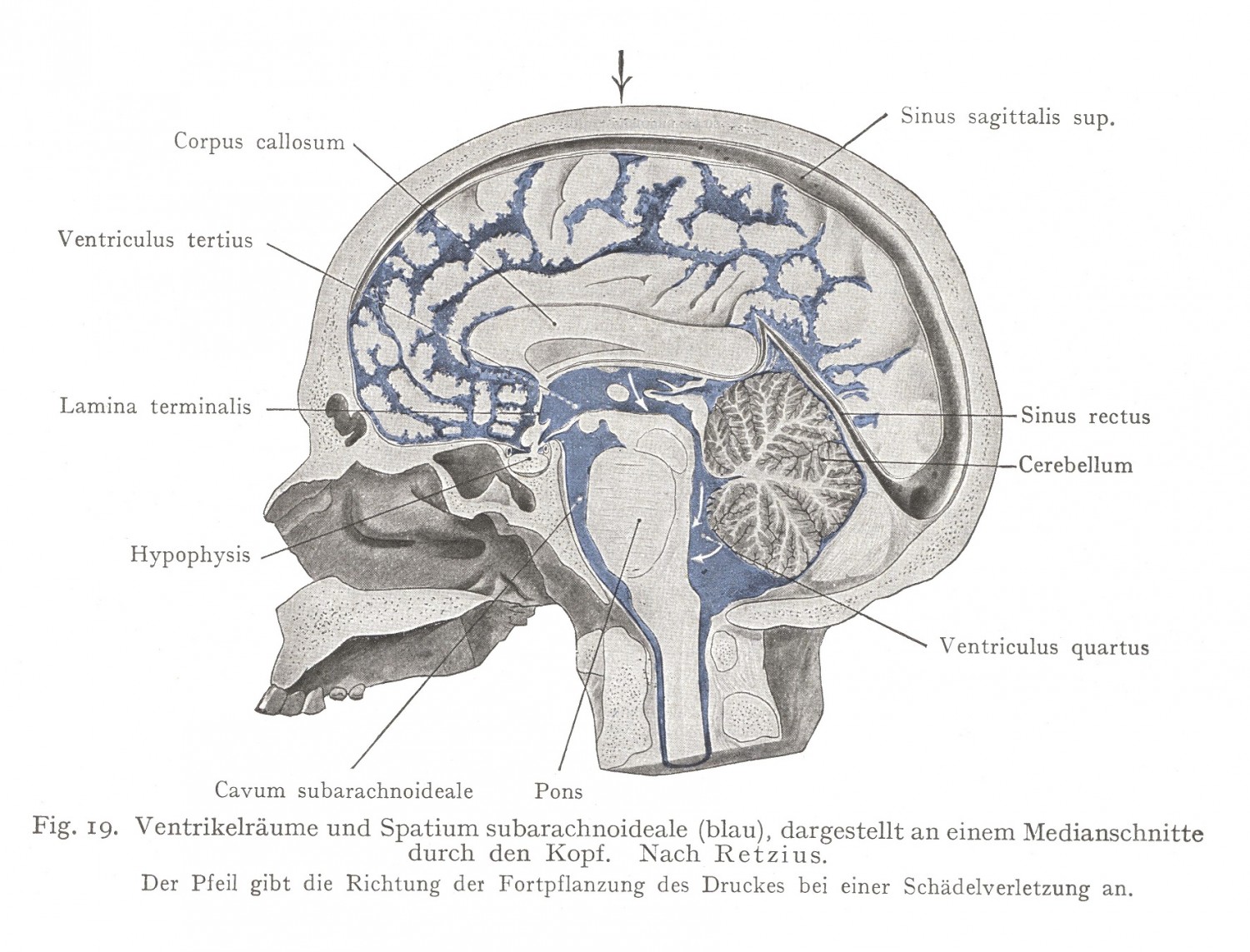 Ventrikelräume und Spatium subarachnoideale (blau), dargestellt an einem Medianschnitte durch den Kopf. Nach Retzius. Der Pfeil gibt die Richtung dei Fortpflanzung des Druckes bei einer Scfiädelverletzung 