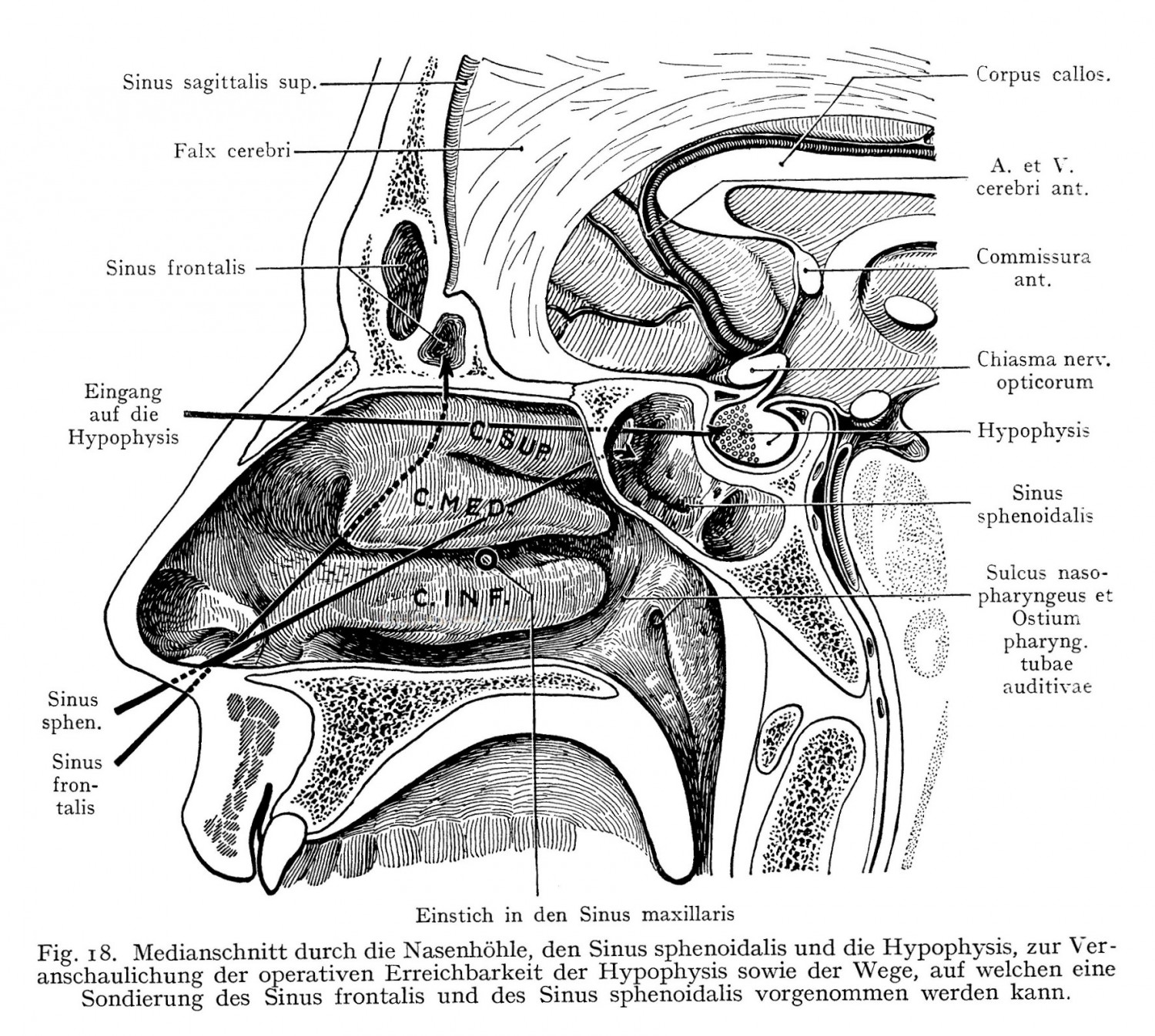 Medianschnitt durch die Nasenhöhle, den Sinus sphenoidalis und die Hypophysis