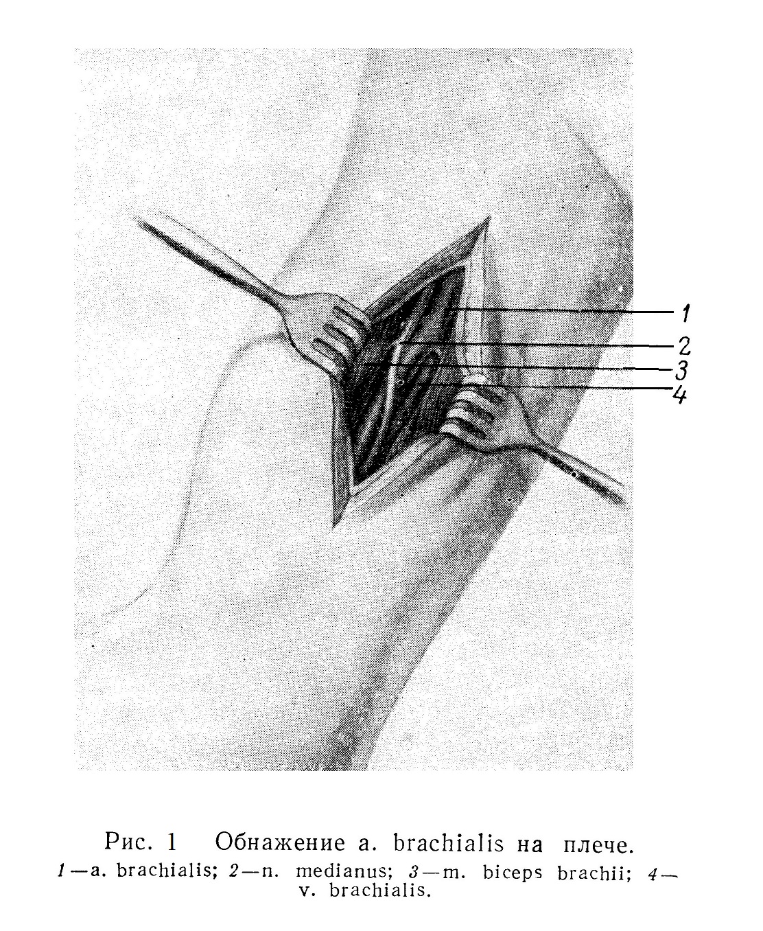 Обнажение а. brachialis на плече.