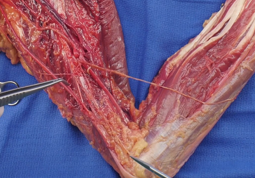 Перевязка локтевой артерии в мышечном отделе