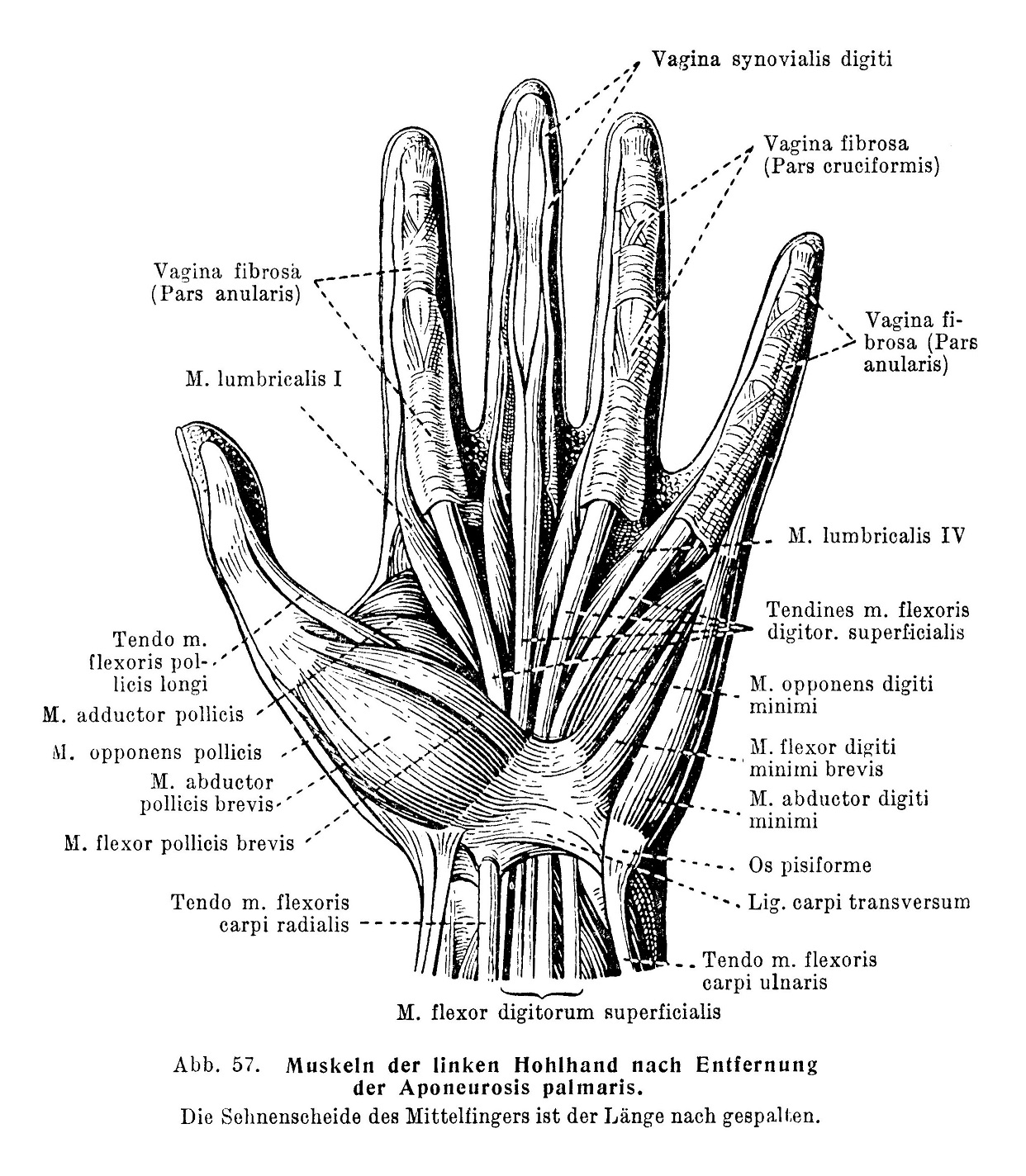 Muskuln der linken Hohlhand nach Entiernung der Aponeurosis palmaris