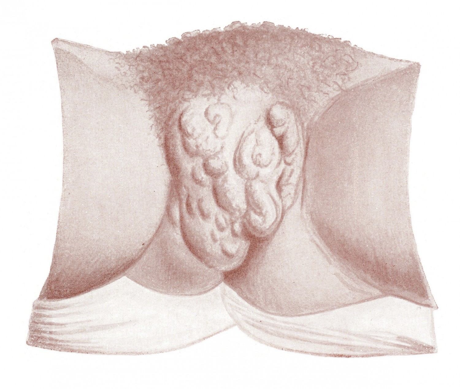 Значительное варикозное расширение вен наружных половых органов при беременности