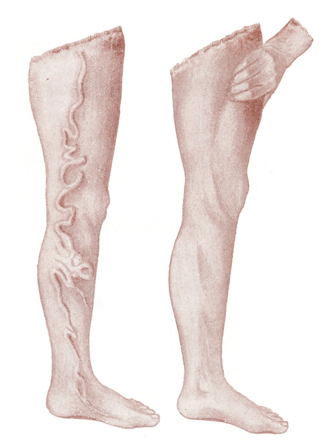 Расширение большой подкожной вены бедра - Varices venae saphenae magnae. Положительный симптом Тренделенбурга. 