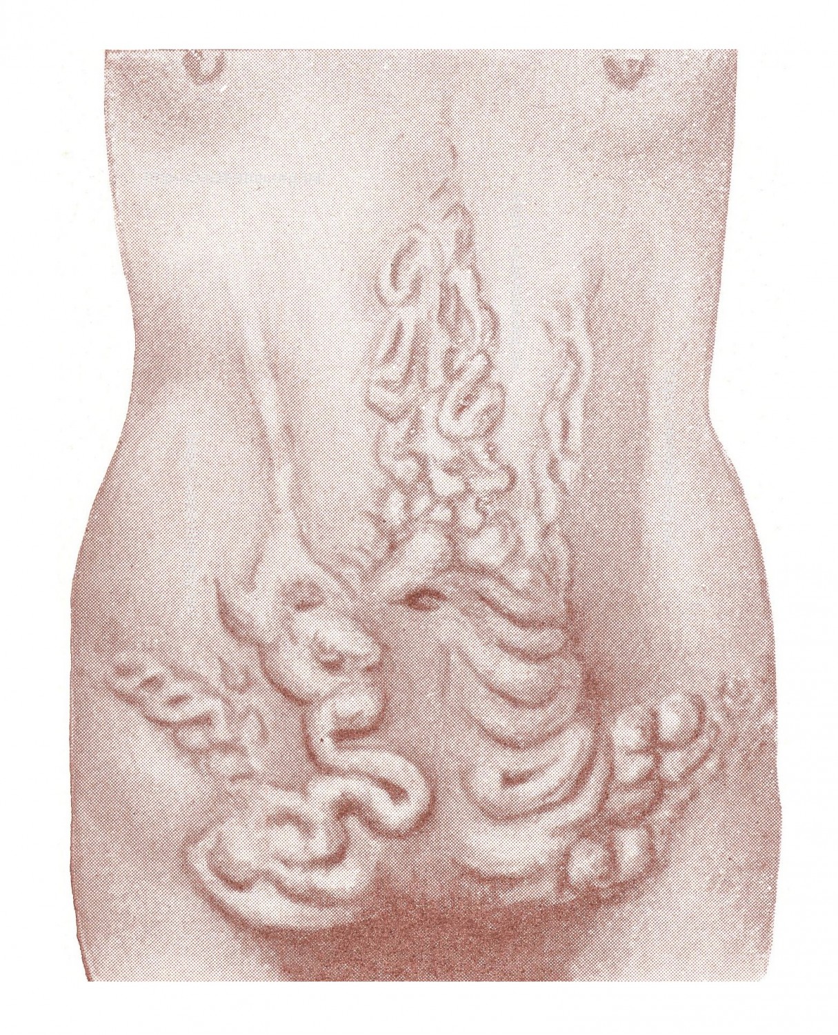 "Caput medusae" после тромбоза нижней половой вены — следствие брюшного тифа