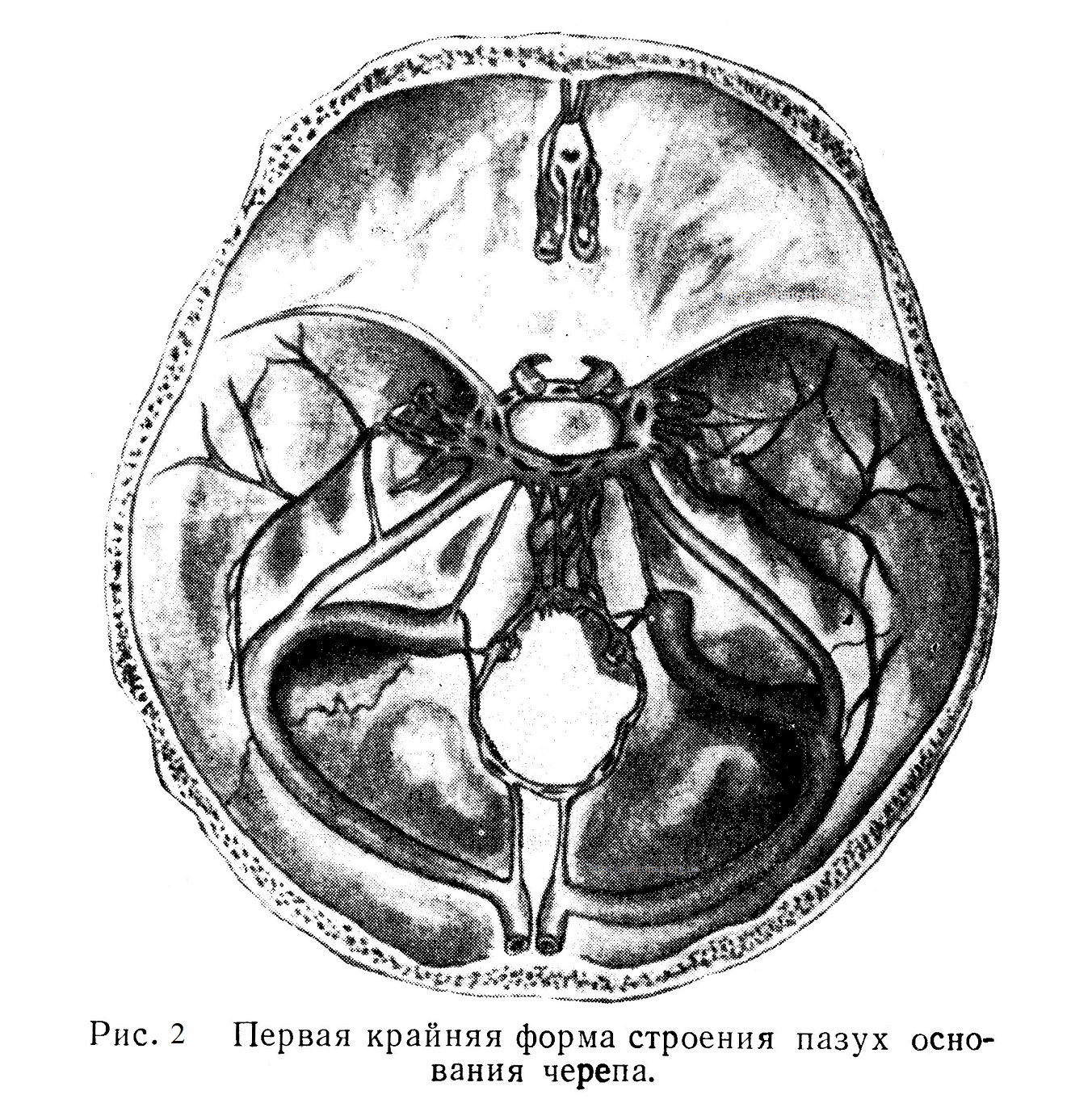 Первая крайняя форма строения пазух основания черепа.