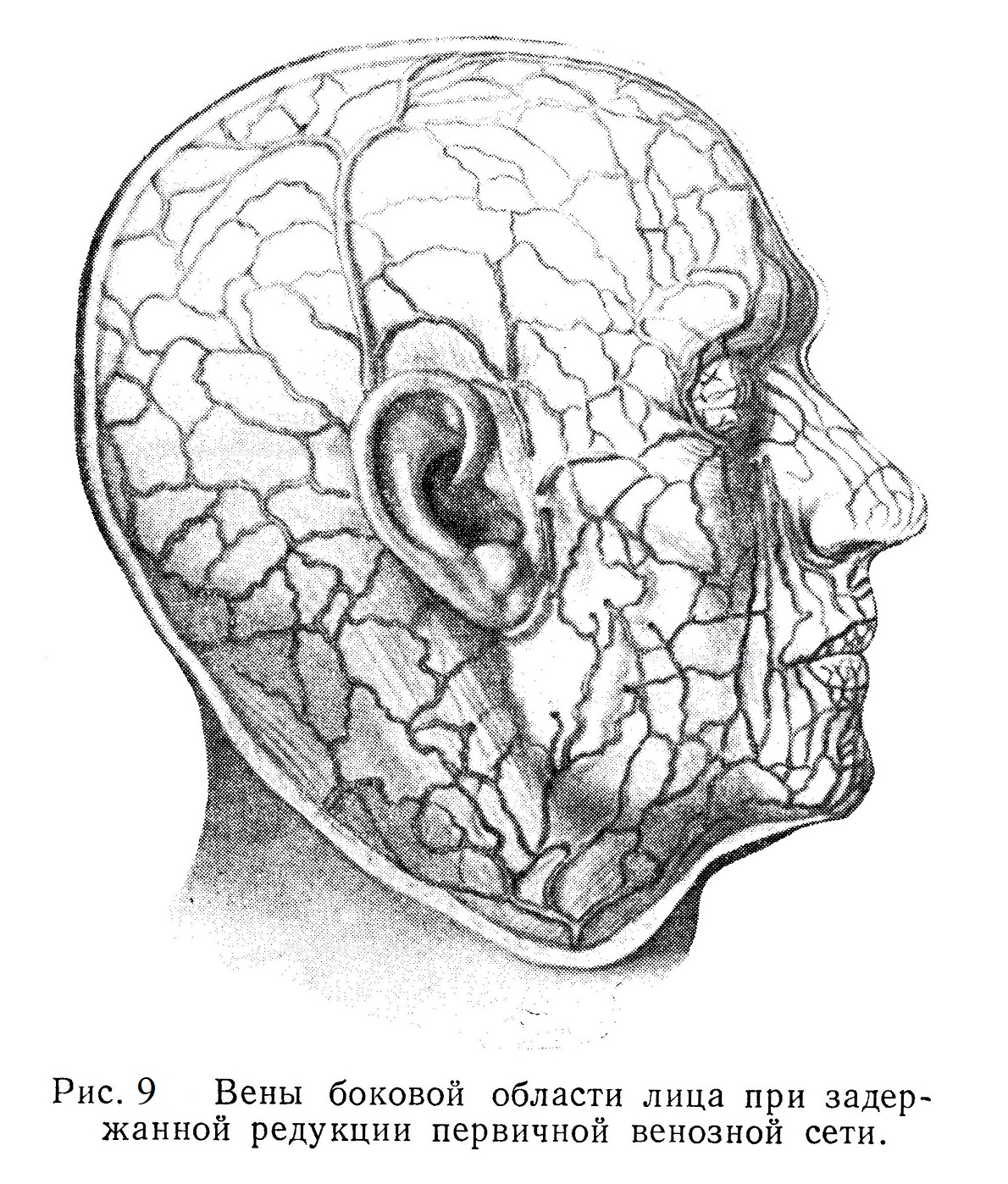 Вены боковой области лица при задержанной редукции первичной венозной сети.
