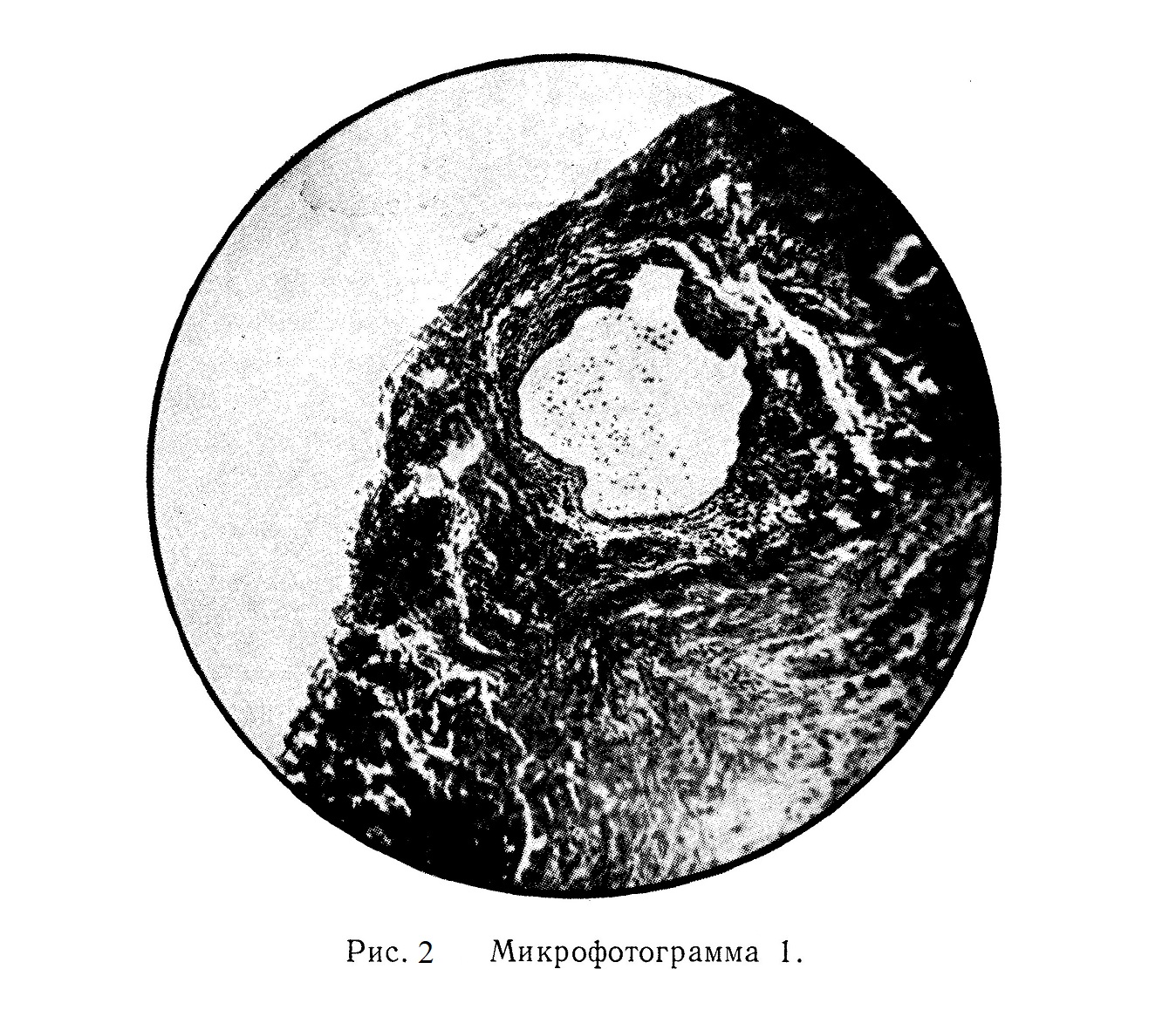 Микроскопически установлен тромбофлебит 
