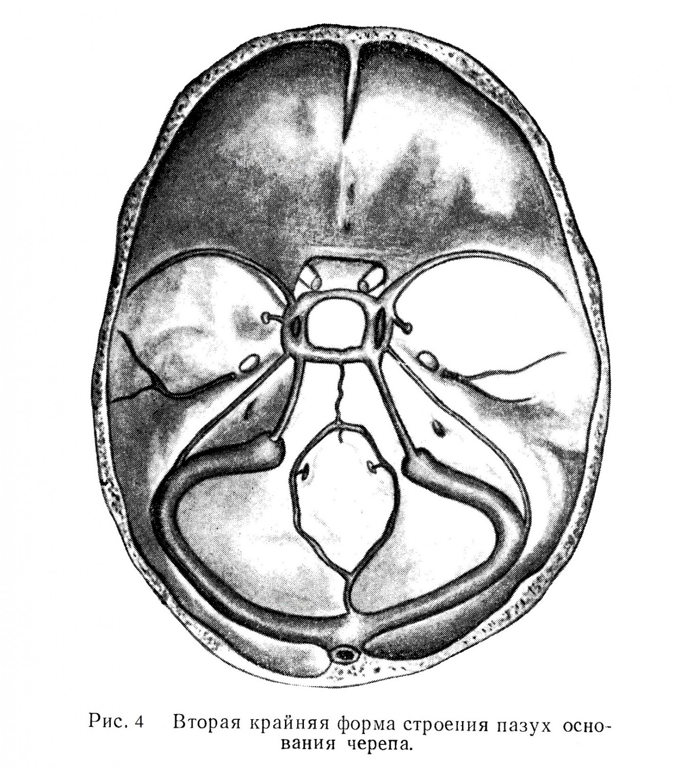 Вторая крайняя форма строения пазух основания черепа.