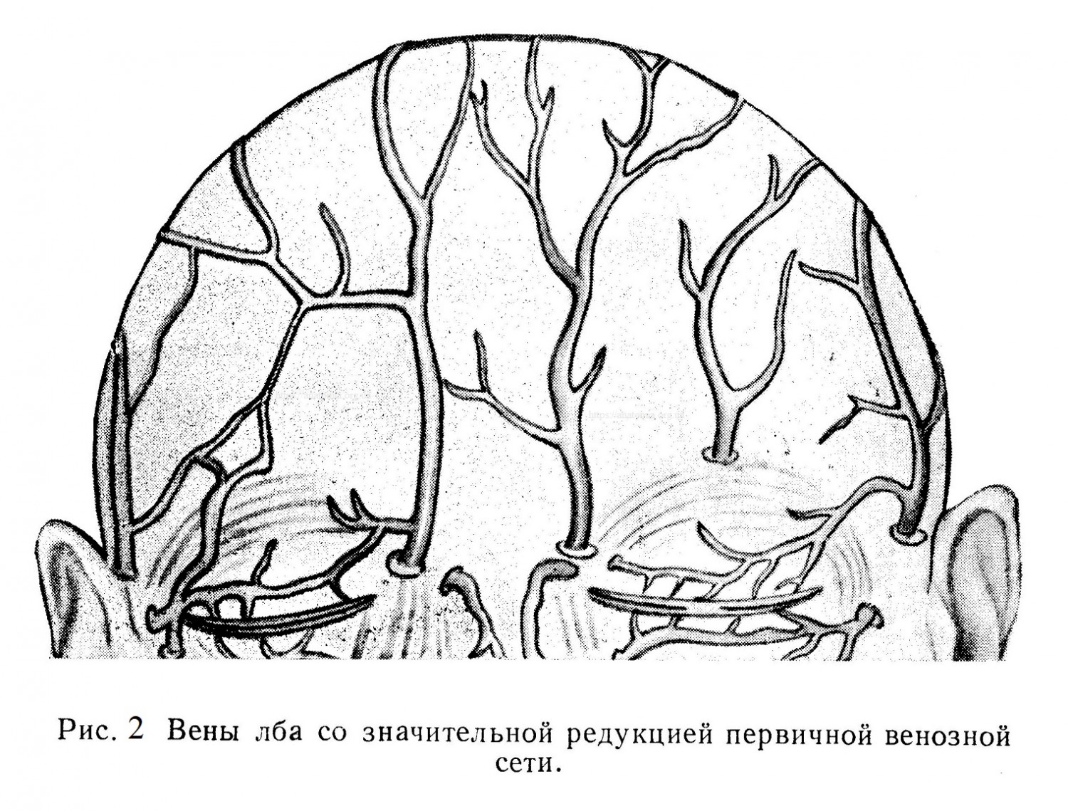 Вены лба со значительной редукцией первичной венозной сети