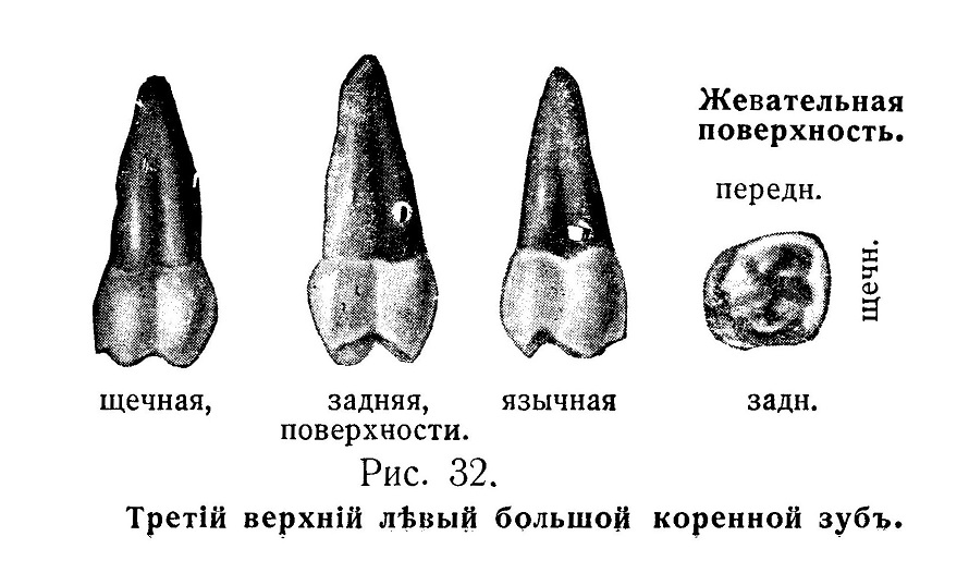 Третей верхний левый большой коренной зуб