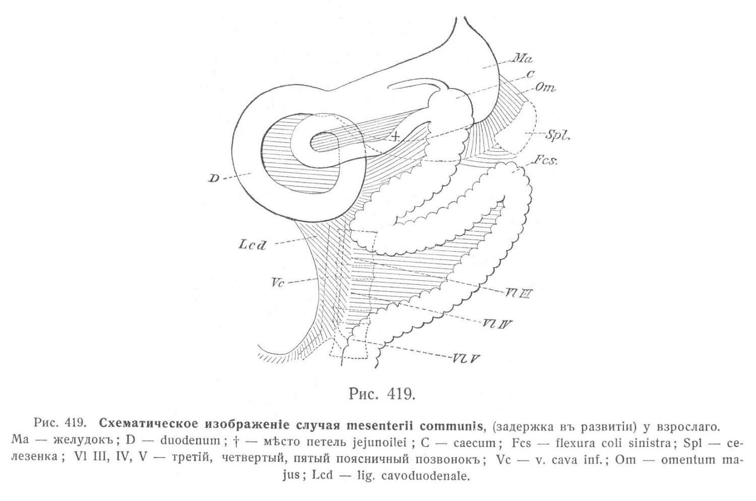 Схематическое изображение случая mesenterii communis, у взрослого.