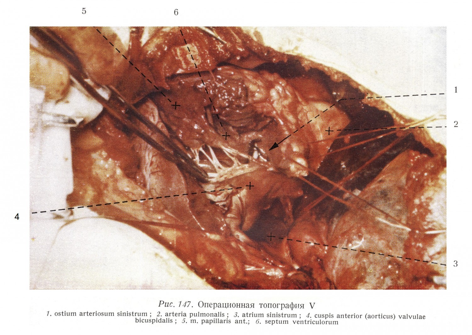 Передний парус. Парус лежит на границе кровотока, идущего из левого предсердия в левый желудочек, и кровотока, идущего оттуда по направлению аорты