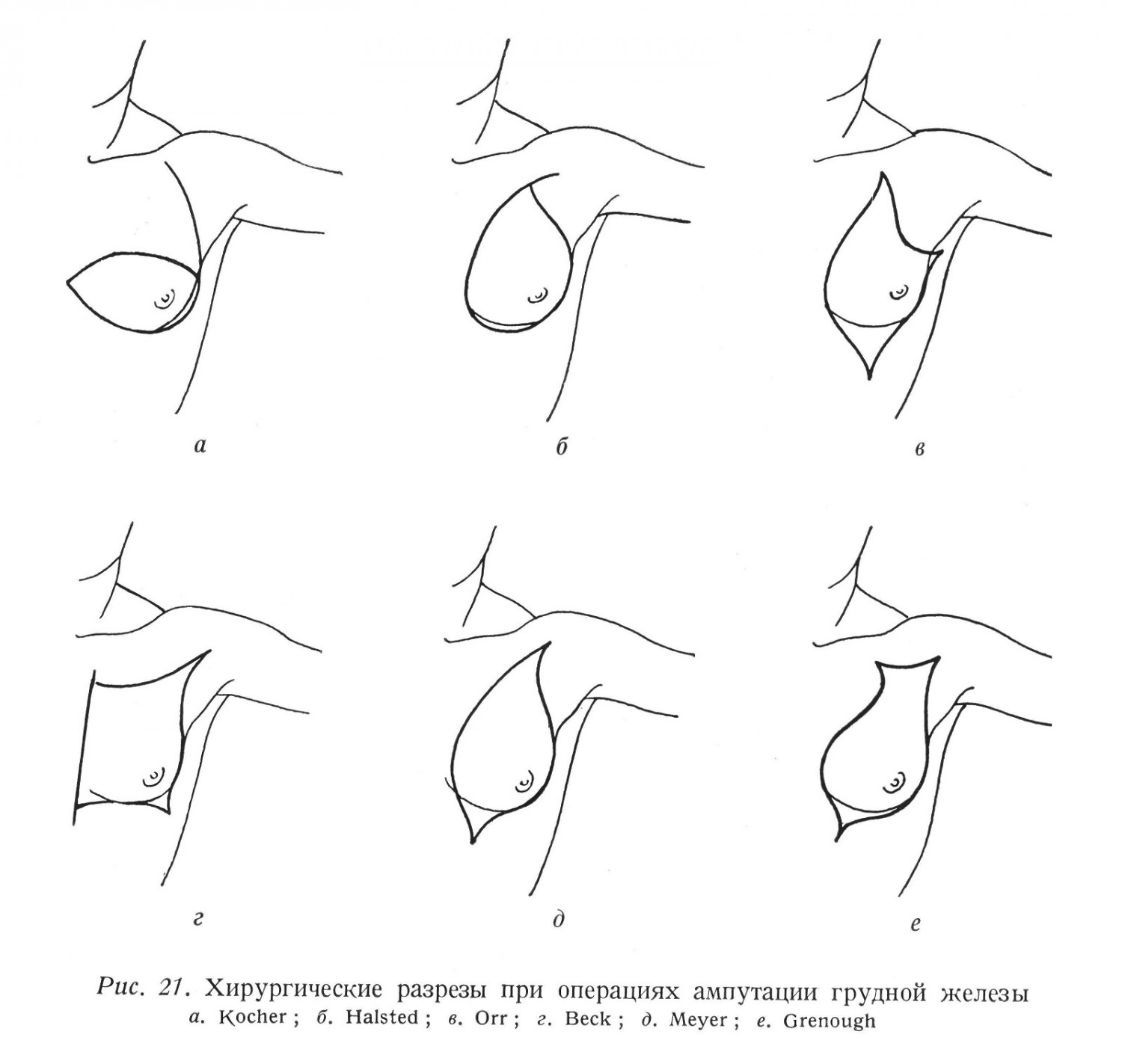 Хирургические разрезы при операциях ампутации грудной железы