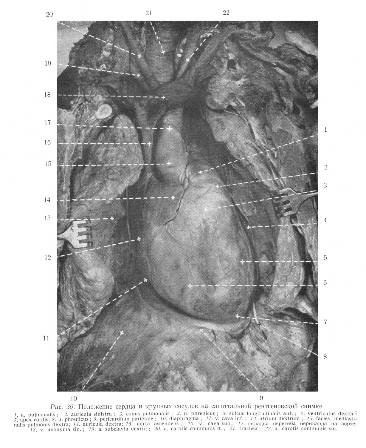 Положение сердца и крупных сосудов на сагиттальной рентгеновской снимке