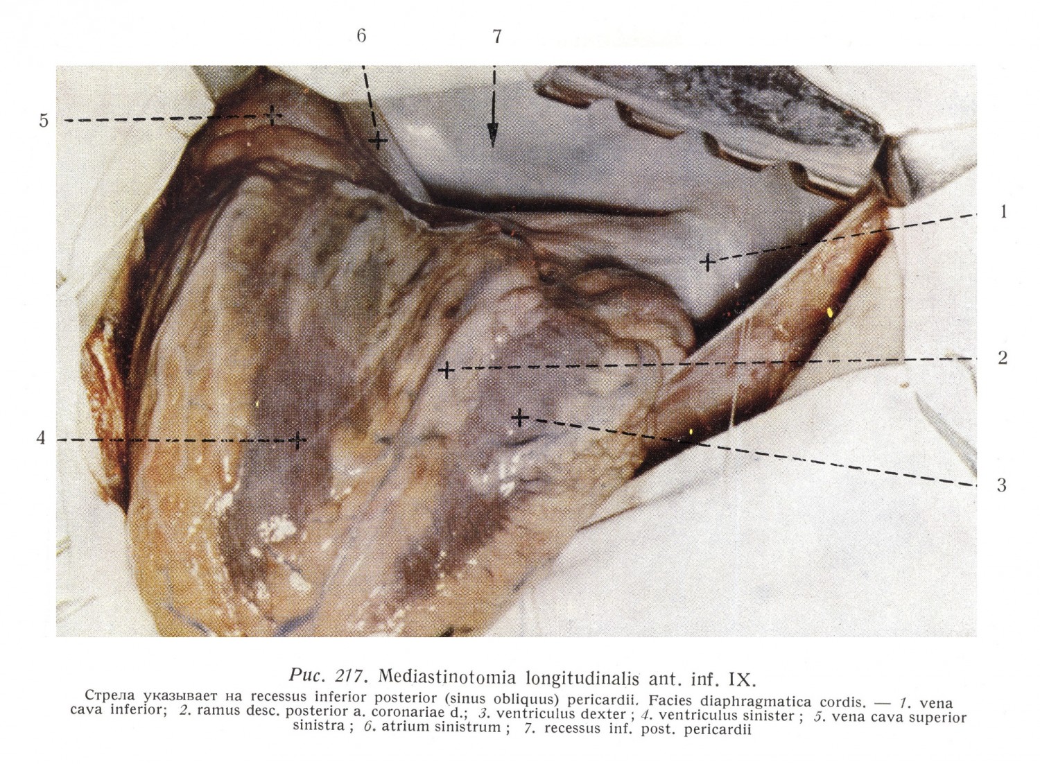Mediastinotomia longitudinalis ant. inf. IX
