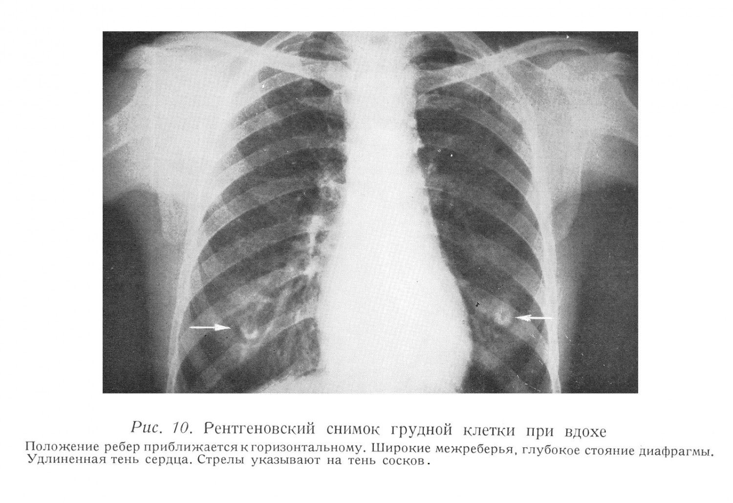 Рентгеновский снимок грудной клетки при вдохе