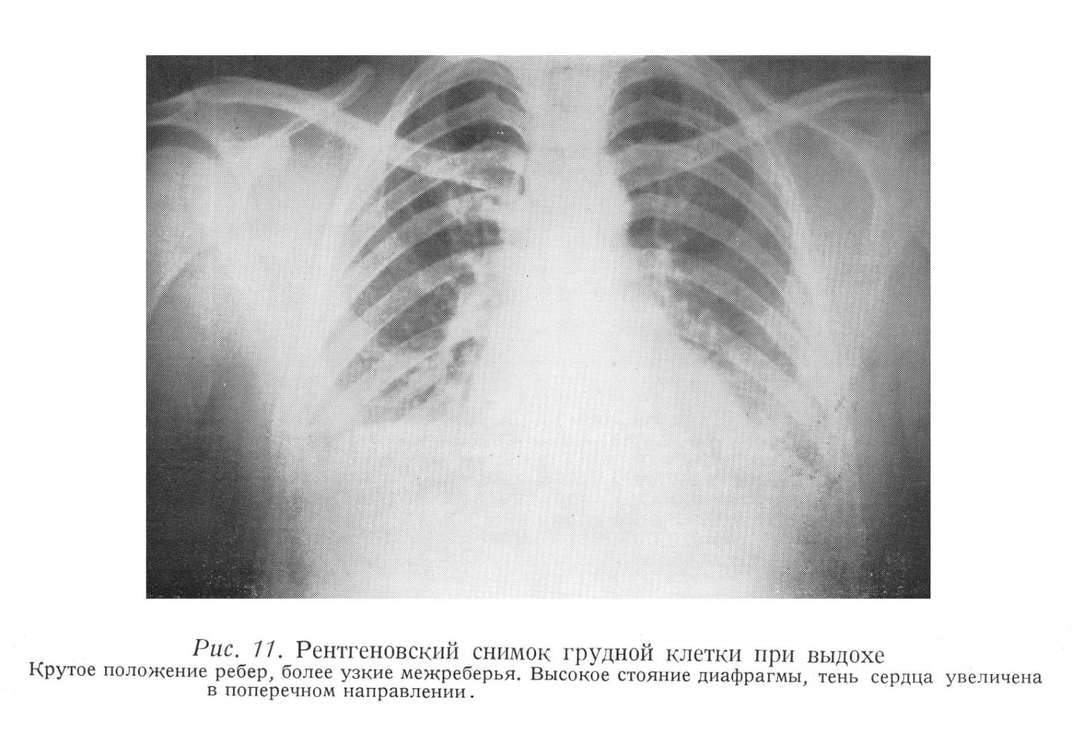 Рентгеновский снимок грудной клетки при выдохе