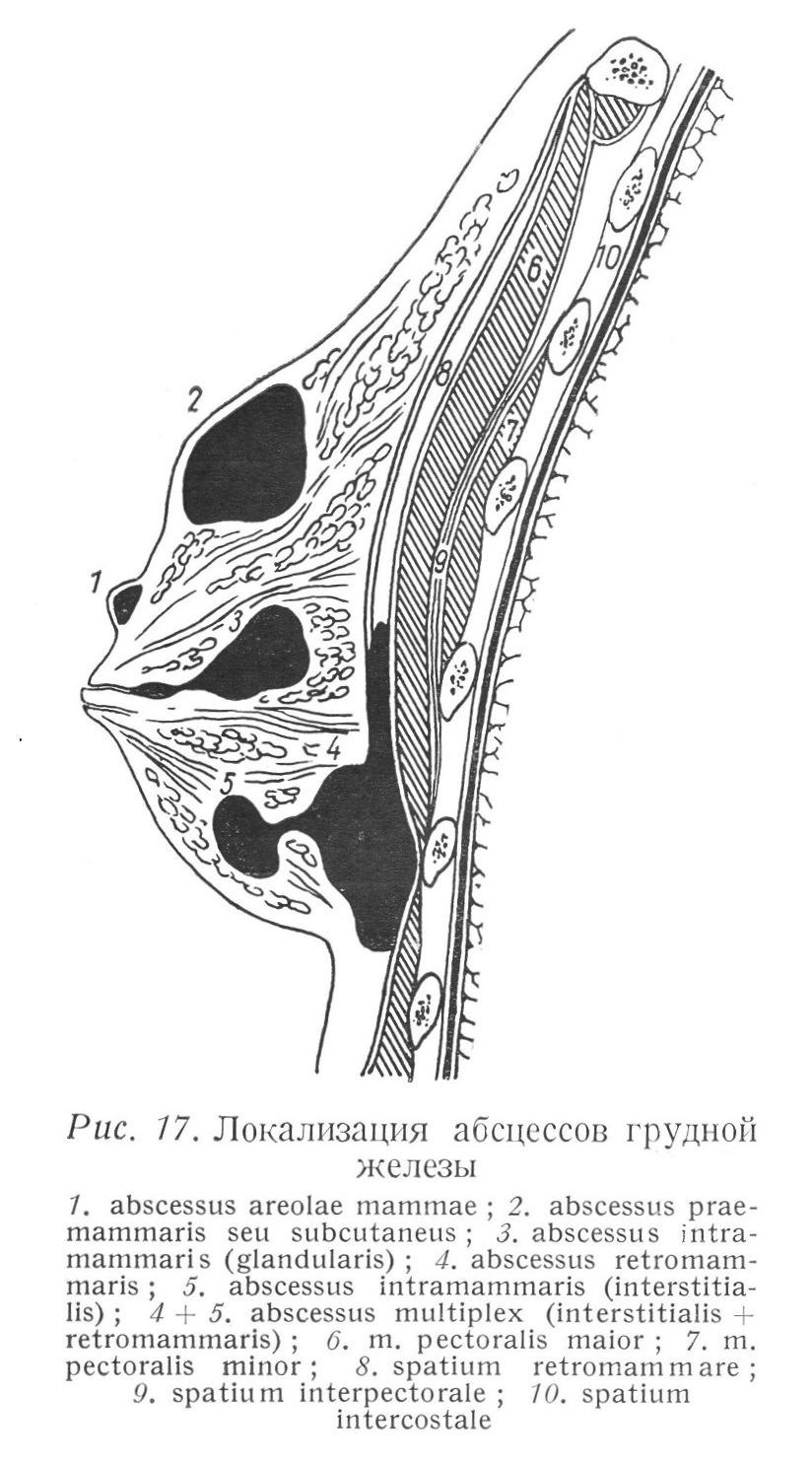 Локализация абсцессов грудной железы