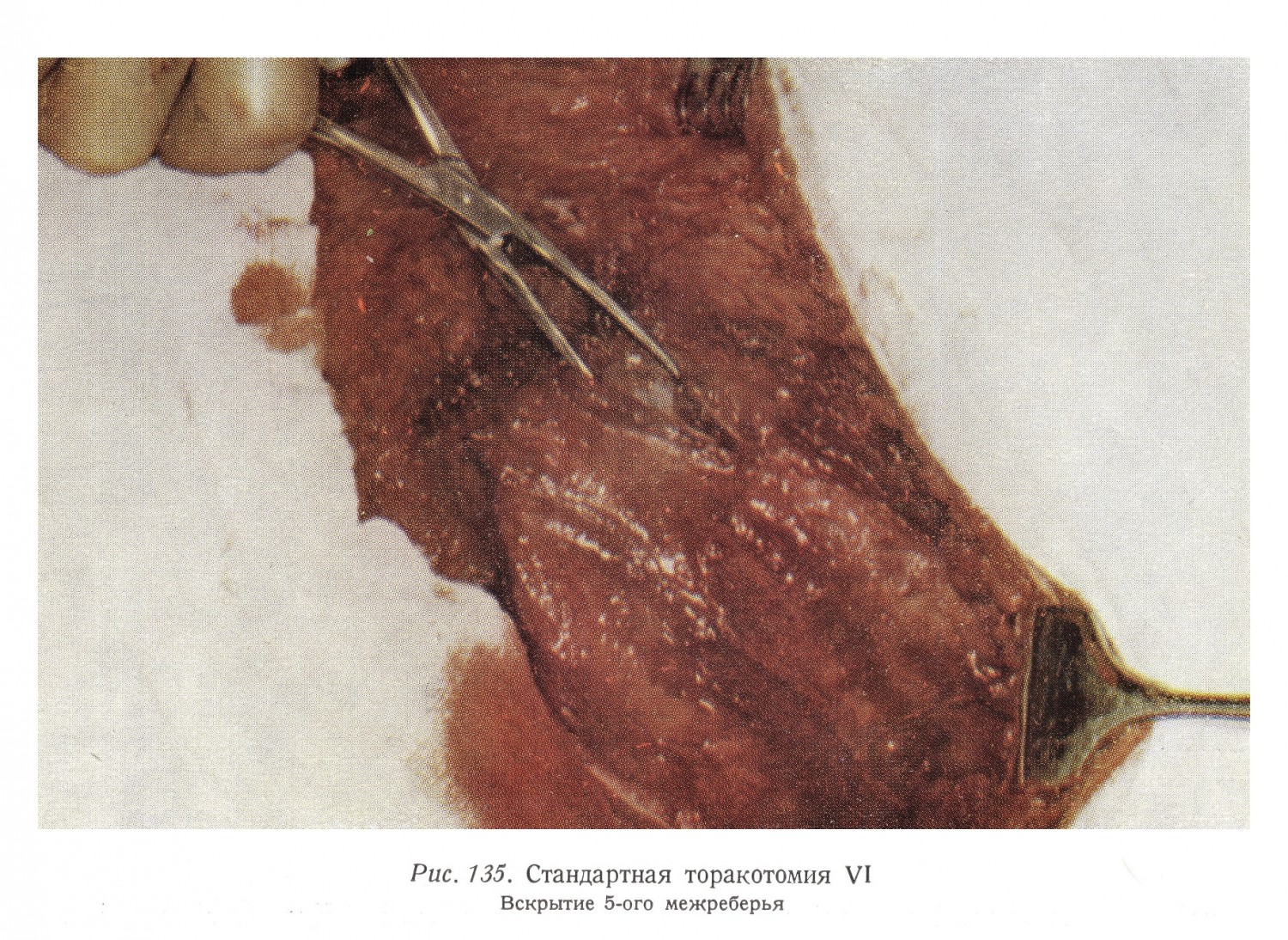 Стандартная торакотомия