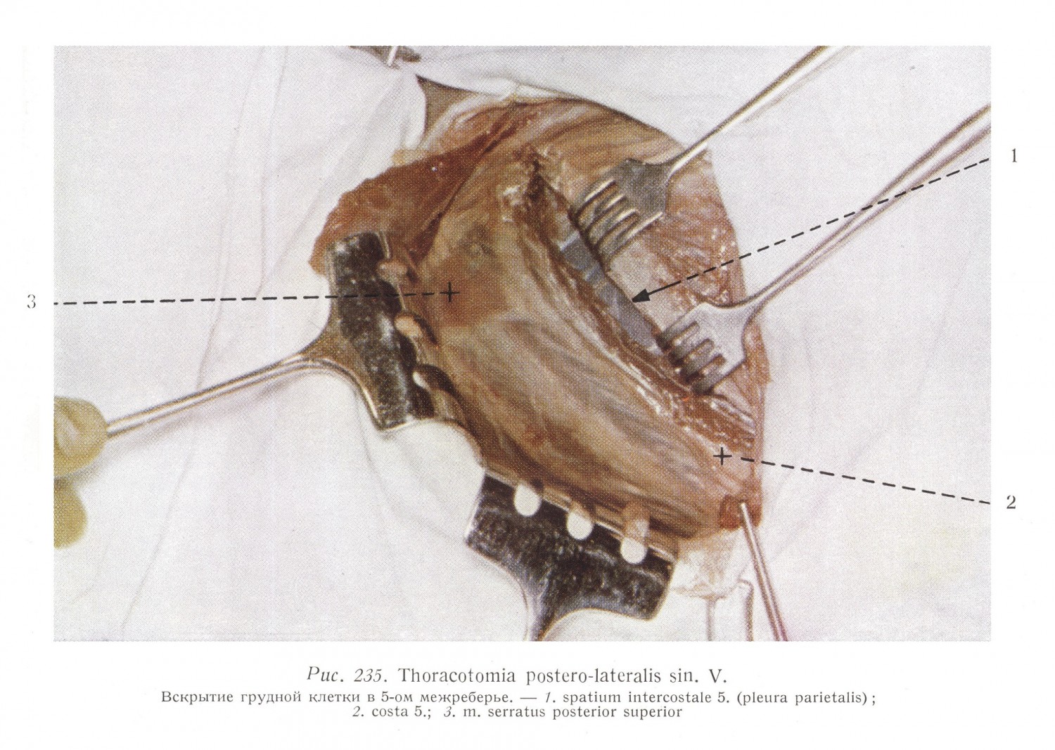 Thoracotomia postero-lateralis sin.